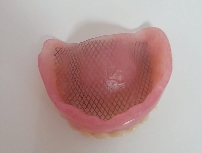 Proteză dentară lucrată în cabinetul nostru